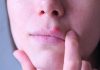 Herpes din cauza stresului: la ce se datoreaza?