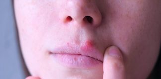 Herpes din cauza stresului: la ce se datoreaza?
