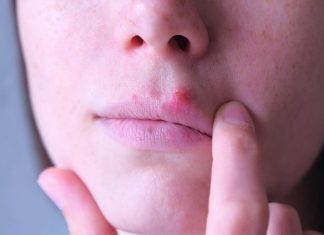 Herpes din cauza stresului: la ce se datoreaza?