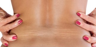 Spune adio vergeturilor cu aceste remedii naturiste