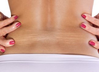 Spune adio vergeturilor cu aceste remedii naturiste